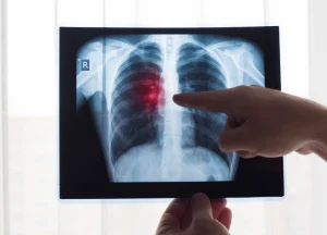 Medical diagram showing lung damage caused by asbestos fiber inhalation